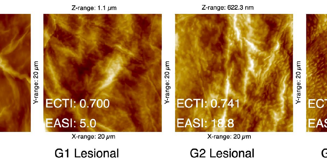 Évaluation de la sévérité de la dermatite atopique à l’aide de l’analyse par microscopie à force atomique de bandes adhésives cutanées.