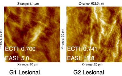 Évaluation de la sévérité de la dermatite atopique à l’aide de l’analyse par microscopie à force atomique de bandes adhésives cutanées.
