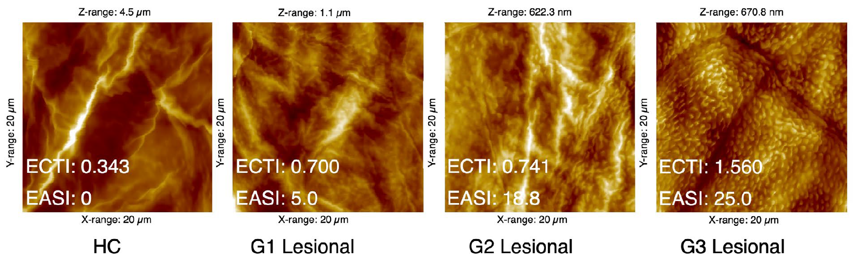 atopic-dermatitis-assessment-AFM-Loretta